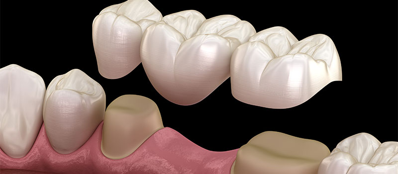 Dental Crowns and Bridges at Hometown Dental in Edgewater, FL